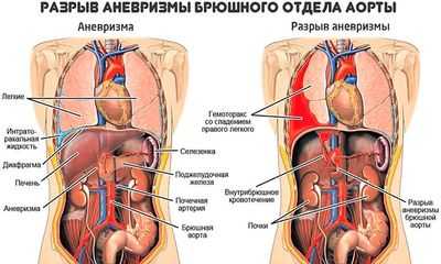 Разрыв аневризмы брюшной аорты