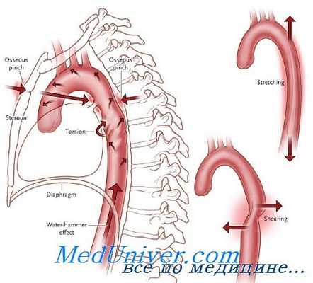 операции при травме аорты