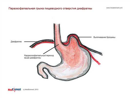 Параэзофагеальная грыжа пищеводного отверстия диафрагмы