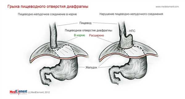 Грыжа пищеводного отверстия диафрагмы