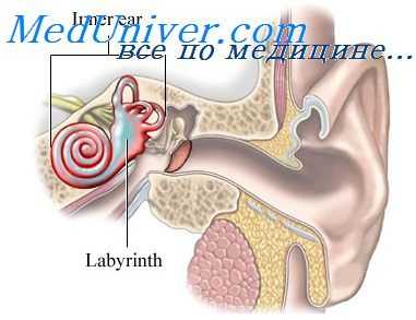 лабиринтит
