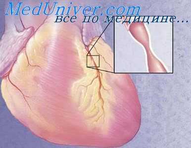 инфаркт миокарда
