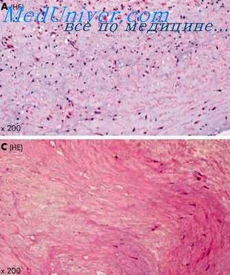 нестабильная стенокардия