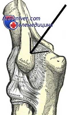 операция гохмана при эпикондилите