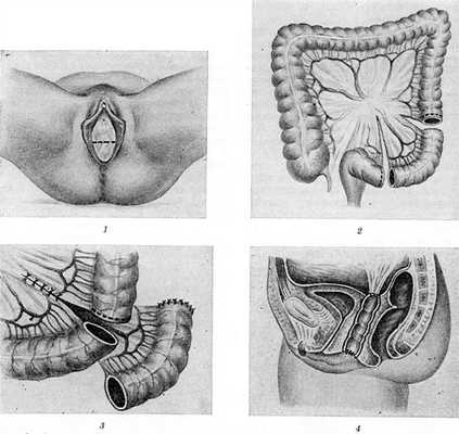 Рис. 2. Схематическое изображение некоторых последовательных этапов кольпопоэза из сигмовидной ободочной кишки (по Гиговскому): 1 — разрез в области входа во влагалище; 2 — резекция участка сигмовидной кишки; 3 — восстановление проходимости кишечника, проксимальный конец трансплантата ушит; 4— трансплантат низведен в ложе, слизистая оболочка его подшита к области входа во влагалище, купол образованного влагалища пришит к тазовой брюшине