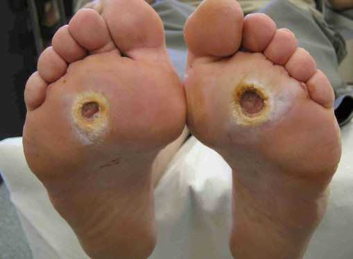 Нейропатические инфицированные стопы