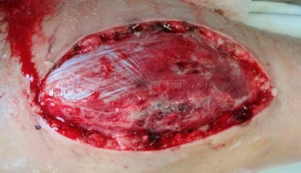 Фасциотомия при СПС