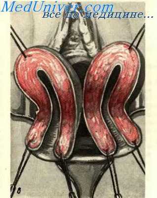 влагалищная экстирпация матки