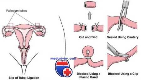 лапароскопическая стерилизация женщин