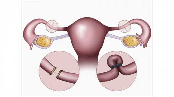 Условно-обратимая и необратимая хирургическая стерилизация