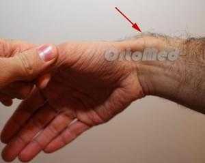 Болезнь де кервена