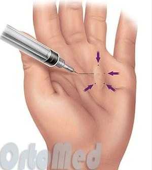 лечение болезни Дюпюитрена