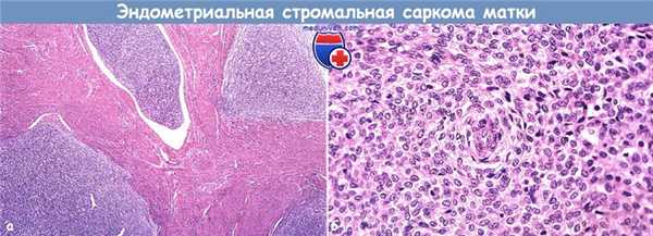 Эндометриальная стромальная саркома матки