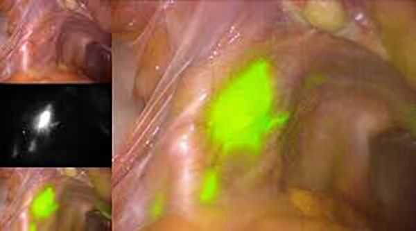 Сигнальные лимфатические узлы. Накопление препарата индоцианин зелёный