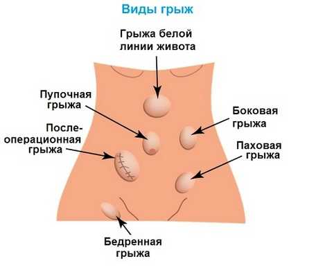 Грыжи на животе