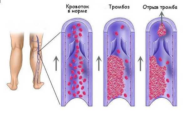 Операция по удалению тромба из вен ног