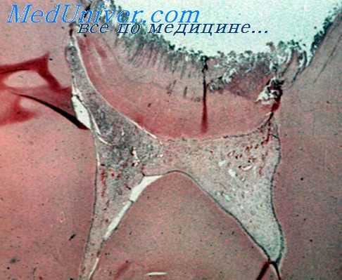 околоверхушечный абсцесс