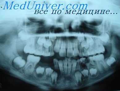 хронический остеомиелит челюсти