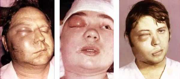 Флегмона при остеомиелите челюсти