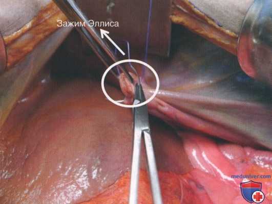 Техника, этапы операции при повреждении диафрагмы