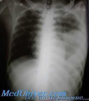 острая травма диафрагмы