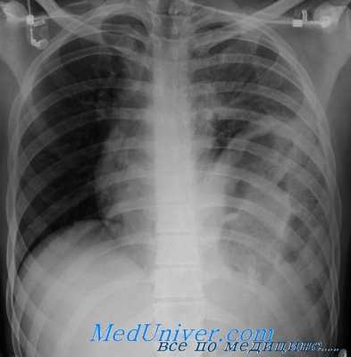 хроническая травма диафрагмы