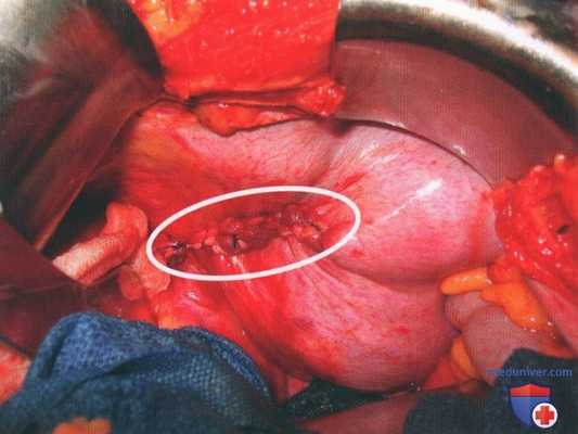 Техника, этапы операции при повреждении диафрагмы