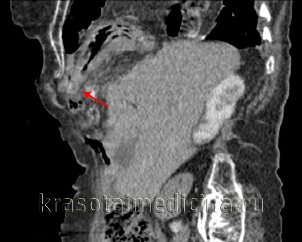 Торакоабдоминальная травма