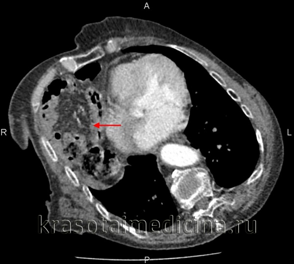 Торакоабдоминальная травма