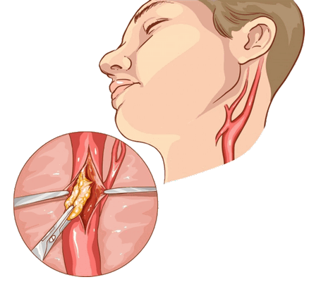Каротидная эндартерэктомия
