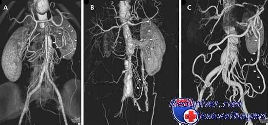 повреждение верхней брыжеечной артерии