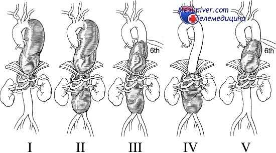 травма аорты над почечными артериями