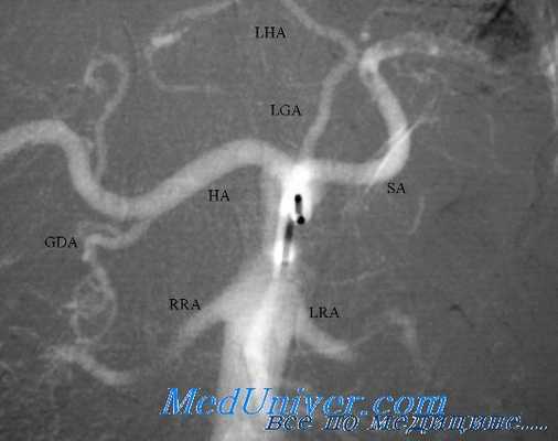 травма почечных артерий