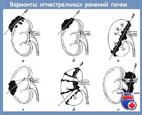 Варианты огнестрельных ранений почки