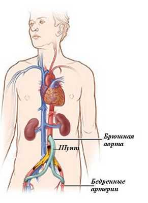 Операция аортобифеморального шунтирования