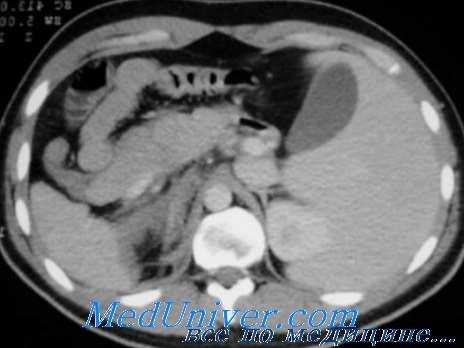 травма сосудов живота