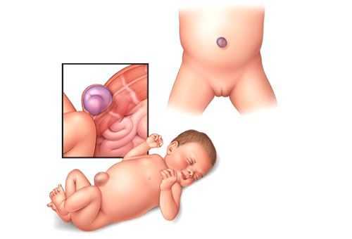 Пупочная грыжка