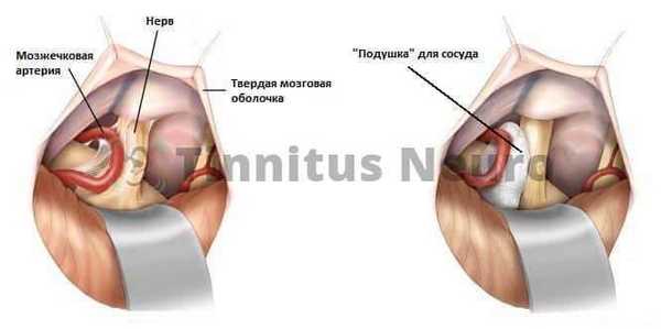 Операция при нейроавскулярном конфликте