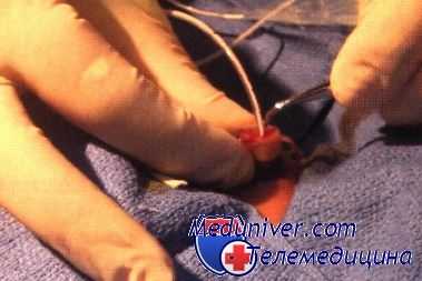 катетеризация пупочной артерии