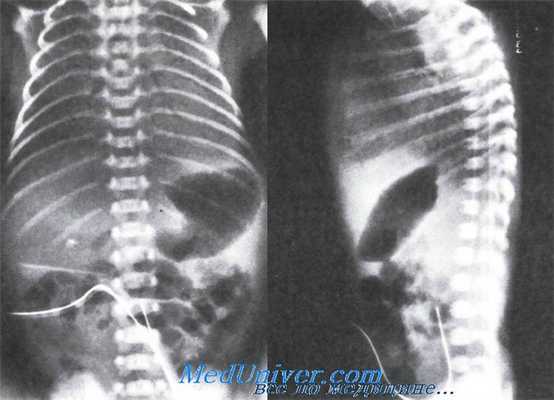 катетеризация пупочной артерии