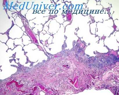 операция якобеуса