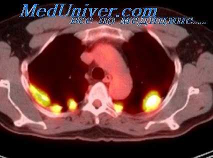 операция якобеуса