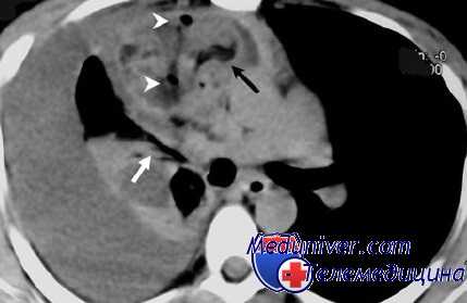 операция якобеуса