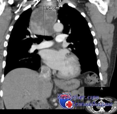 техника торакоскопии