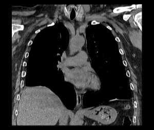 релаксация правого купола диафрагмы на КТ