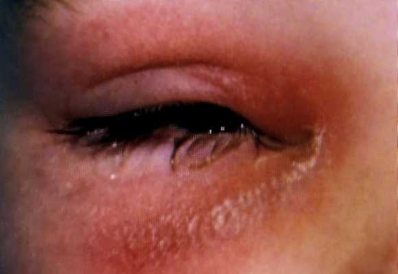 Орбитальный целлюлит