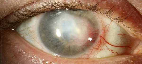 Герпес глаза симптомы