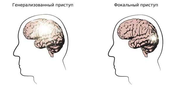 Фокальная эпилепсия