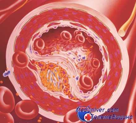 липопротеиды крови