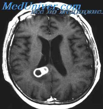 абсцесс мозга